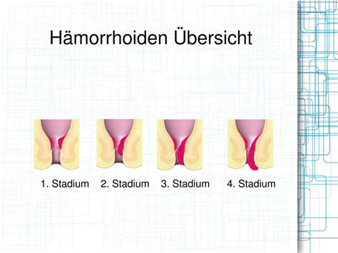 Bilder von Hämorrhoiden: Vier Schweregrade